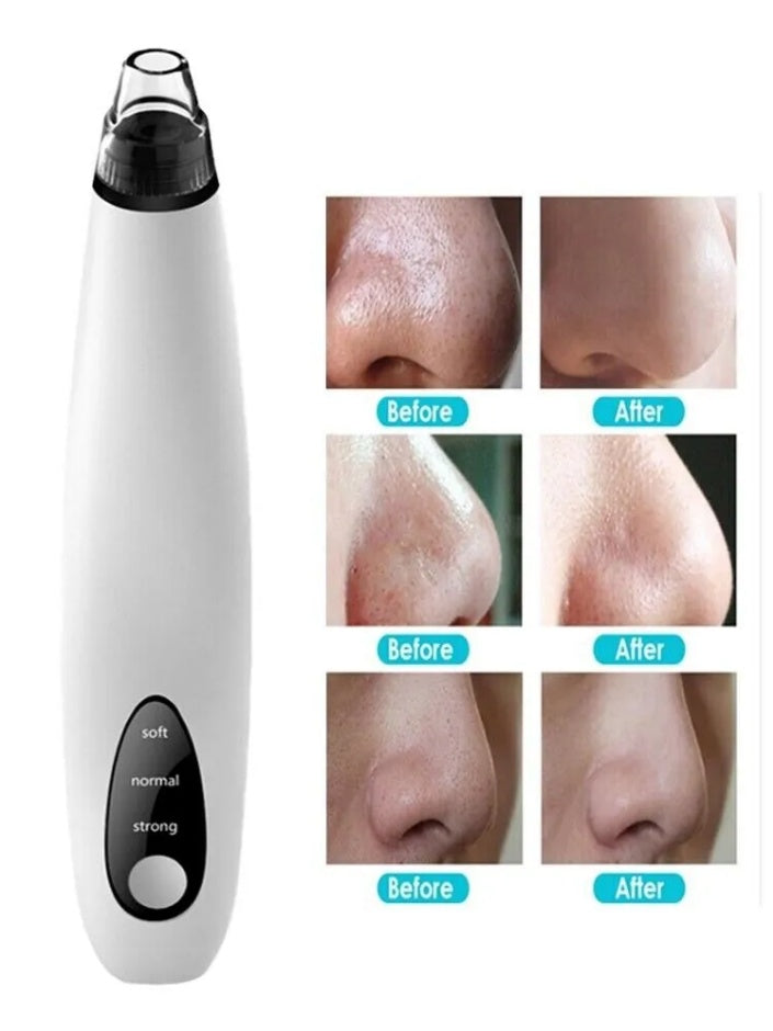 Diamond Pore Vacuum — Electric Blackhead & Whitehead Remover