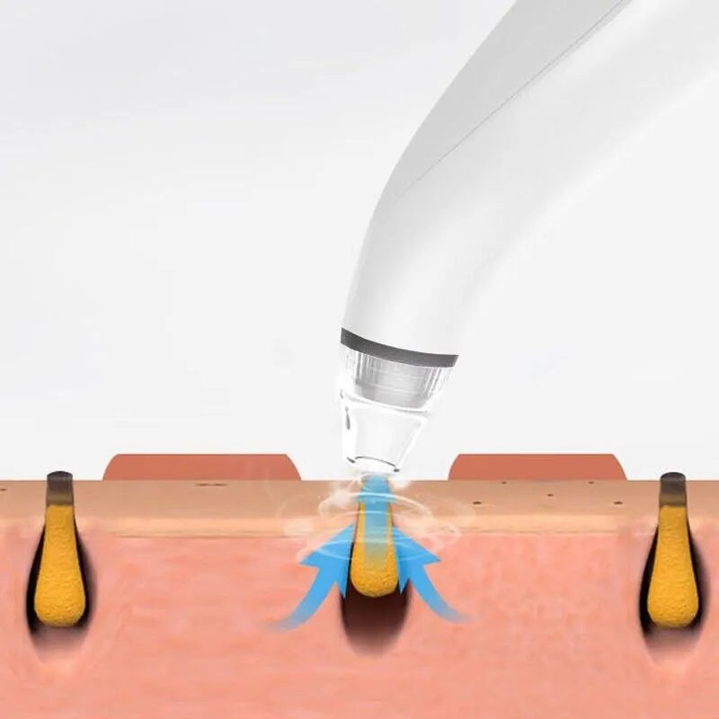 Diamond Pore Vacuum — Electric Blackhead & Whitehead Remover